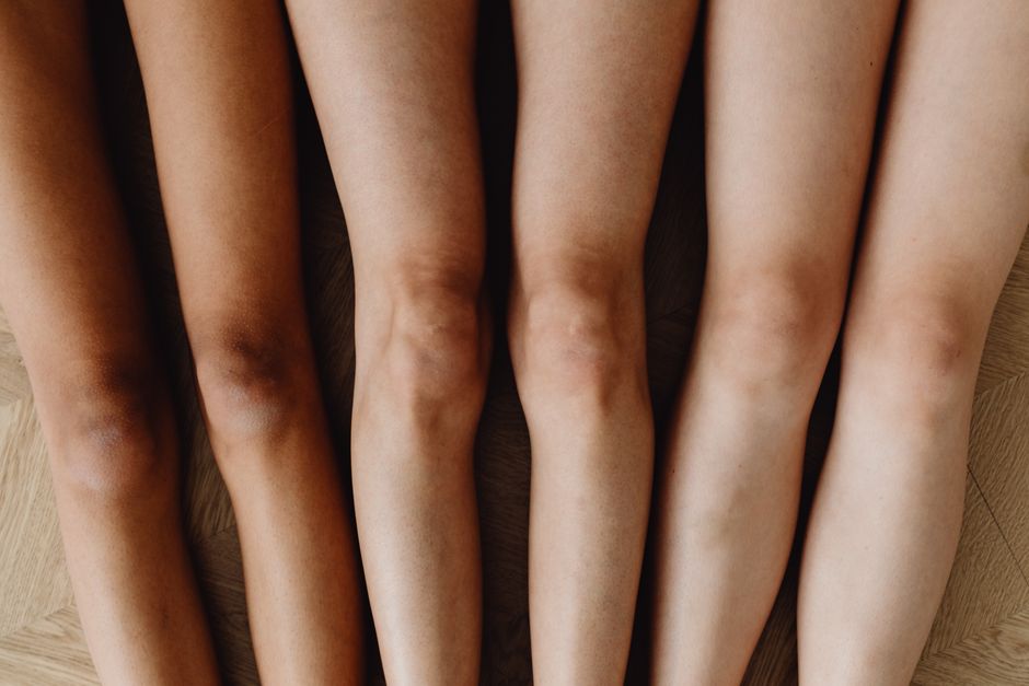 Knee Hyperpigmentation: How to Lighten Dark Knees Safely